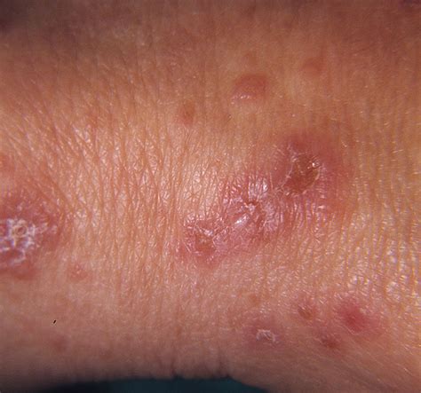 Dermatitis Herpetiformis Picture Hardin Md Super Site Sample
