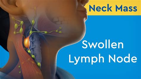 What Causes Swollen Lymph Nodes In Shoulder Mastery Wiki