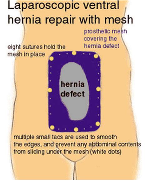 Ventral Hernia Definition Symptoms Causes Repair Surgery