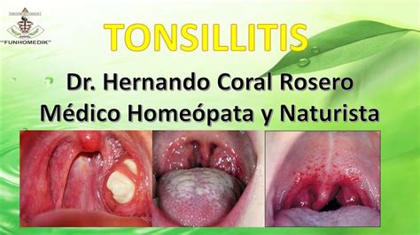 Tonsillitis InflamaciÓn E InfecciÓn De Las Tonsilas AmÍgdalas Youtube