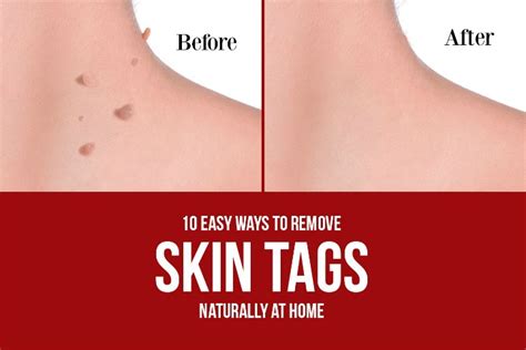 how to remove skin tags naturally at home