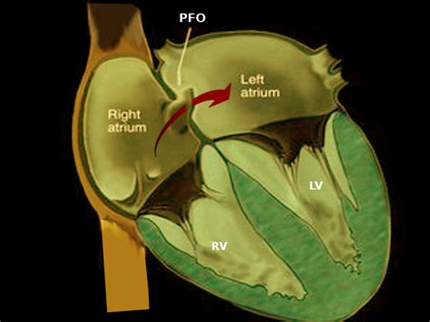 Catheter Management Of Patent Foramen Ovale Treatment And Management