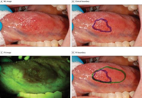 Fluorescence Visualizationguided Surgery For Early Stage