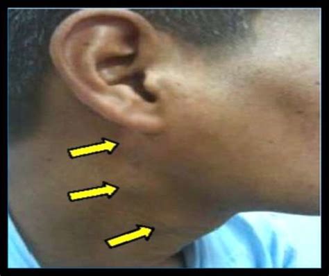 Submandibular Lymph Nodes Swelling Causes
