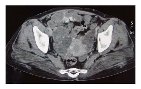 Axial Pelvic Ct Scan Demonstrates Multiple Cystic Masses Arrow In The
