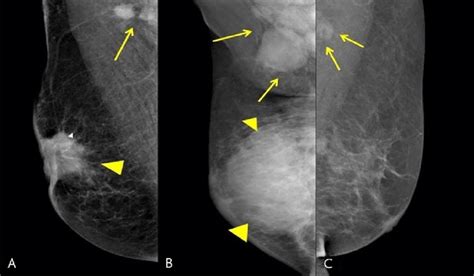 Three Mammographic Images Of Biopsy Proven Metastatic Lymph Nodes From