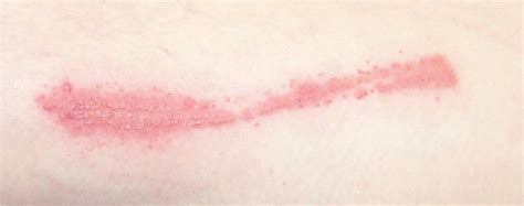 Diagnosis And Management Of Contact Dermatitis Aafp