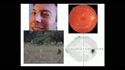Automated Visual Field Part 2 Patterns Youtube