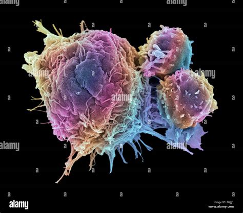 T Lymphocytes And Cancer Cell Coloured Scanning Electron Micrograph