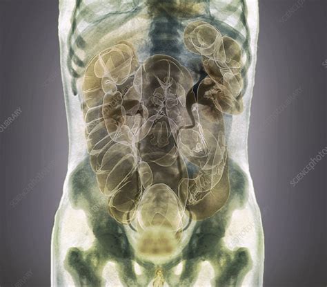 Healthy Abdomen Composite Ct Scan Stock Image C0211959 Science