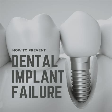 How To Prevent Implant Failure West Palm Beach Dentist