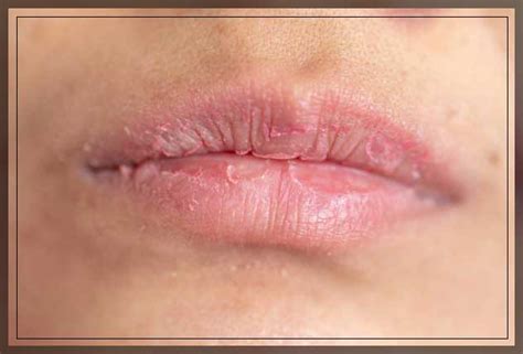 Chapped Lips Treatment And Prevention Dentist Ahmed