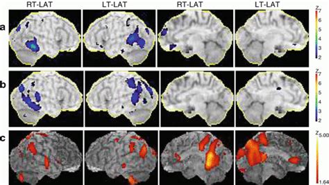 Neuroimaging Of Dementia With Lewy Bodies Radiology Key