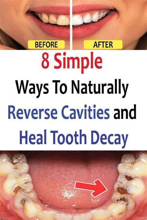 Following proper dental hygiene can also help to curb the plaque that forms on your. 8 Simple Ways to Naturally Reverse Cavities and Heal Tooth ...