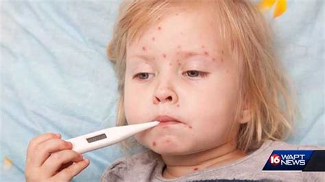 ‘chickenpox Parties Not The Way To Go Doctor Says