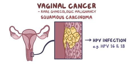 Vaginal Cancer Clinical Practice Video Anatomy Osmosis