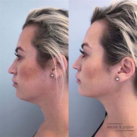 Kybella To Contour Jaw Line Cheek Fillers Kybella Facial Aesthetics