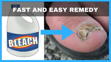 How To Get Rid Of Toenail Fungus With Bleach Toe Fungus Journey Youtube