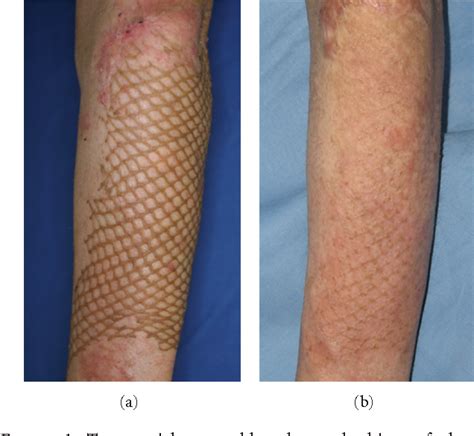 List 99 Pictures Burn Skin Graft Before And After Pictures Stunning 10