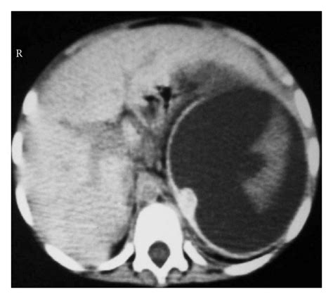 Abdominal Ct Scan Showing A Large Splenic Abscess Note The Sequestrum