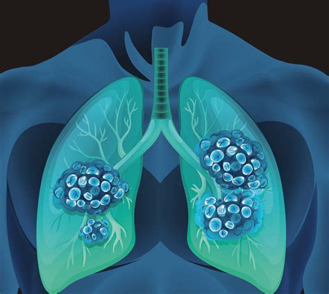 Combination Therapy Improves Small Cell Lung Cancer Survival
