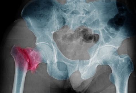 Lower Postoperative Mortality With Hip Fracture Surgery On Day Of