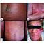 Examples Of Cutaneous Lesions Observed In ATL A Chronic Form With 