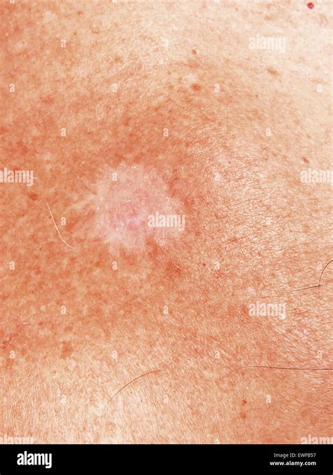 Basal Cell Carcinoma Bcc Immagini E Fotografie Stock Ad Alta