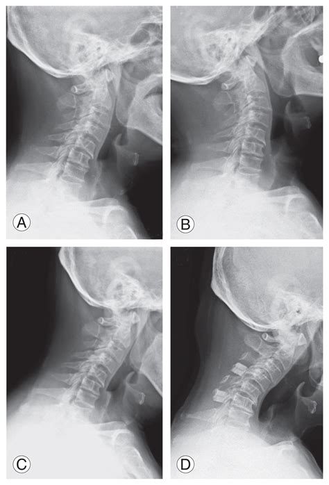 Differences In Risk Factors For Decreased Cervical Lordosis After