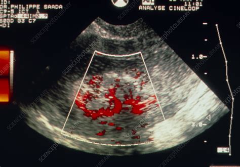 Doppler Ultrasound Of Polyps In The Human Uterus Stock Image M850