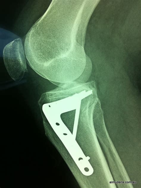 Tibial Plateau Fracture Fixation Xrays And Post Op