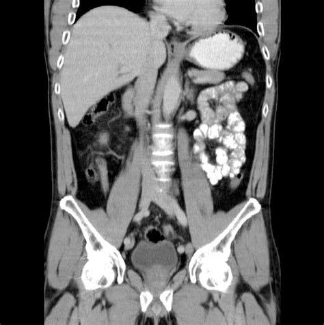 What Is A Pancreas Ct Scan Two Views