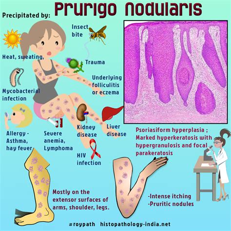 Prurigo Nodularis Intense Itching Pathology Medical Mnemonics