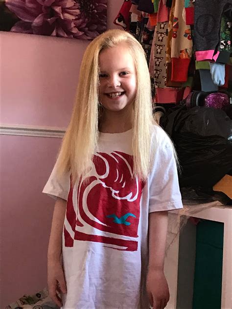Girl With Uncombable Hair Syndrome She Looks Like Albert Einstein