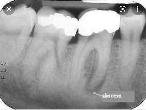 Periapical Abscess Radiograph