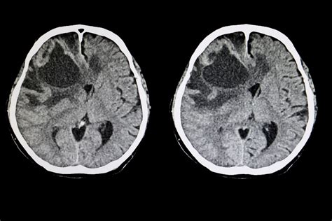 ‘alarming Rise In Brain Metastases As Cancer Patients Miss Follow Up