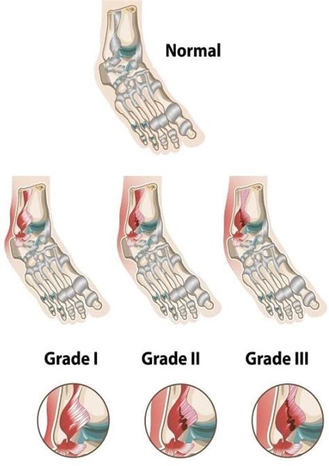 Ankle Sprain Symptoms Diagnosis And Treatment Medfog