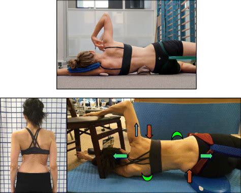 The Schroth Side Lying Exercise For Major Lumbar Curves Top And