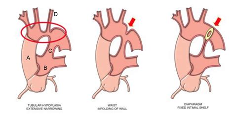 Coarctation Of The Aorta Wfsa Resources