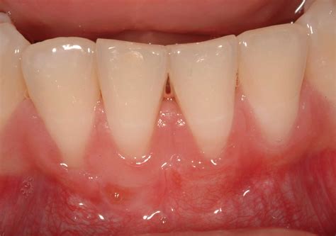 Gum Regeneration Institute Of Dental Implants And Periodontics
