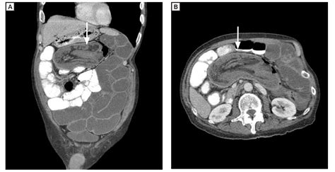 Ileocecal Intussusception