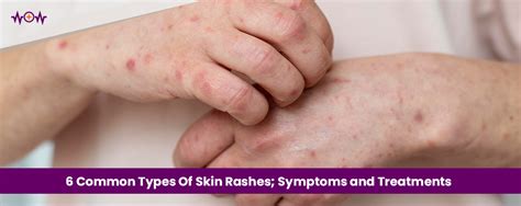 6 Common Types Of Skin Rashes Symptoms And Treatments