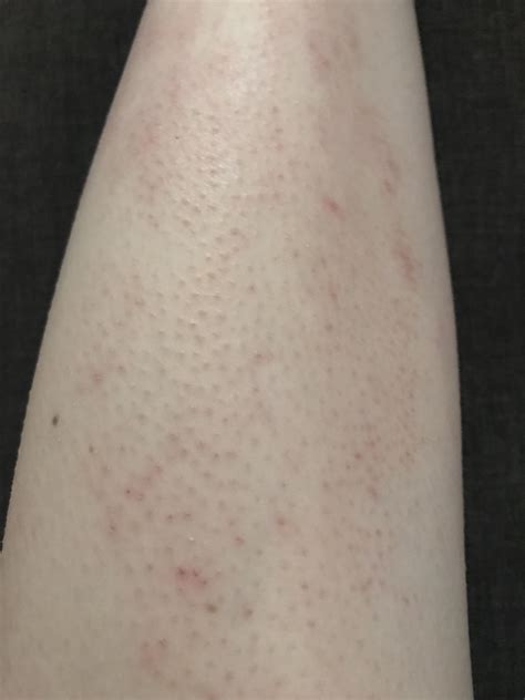 Skin Concern Super Itchy Skin All Over Body Since September Worse On