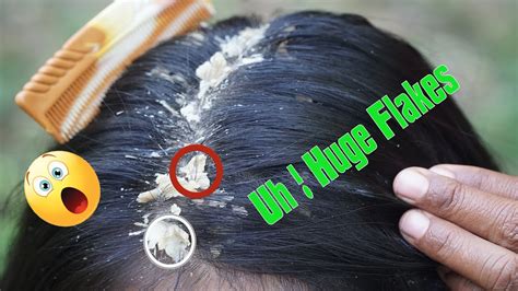 Psoriasis Treatment Huge Flakes Dandruff Scratching 134 Youtube