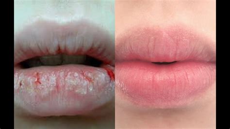 How To Remove Dead Skin From Lips Naturally