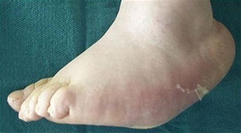 Diabetic Charcot Neuropathy Foot And Ankle Orthobullets