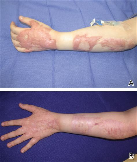 Management Of Trauma And Burn Scars The Dermatologists Role In
