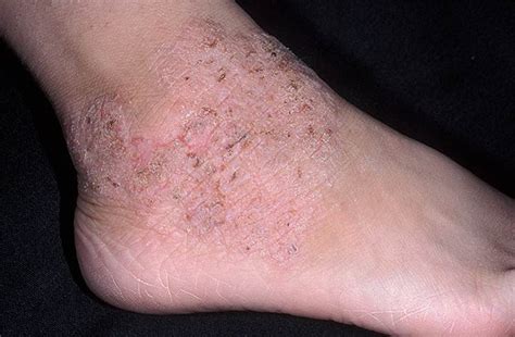 Nummular Dermatitis Pictures Legs Symptoms And Pictures