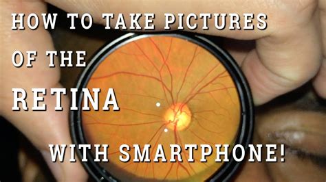 Retinal Photography With Smartphone Youtube