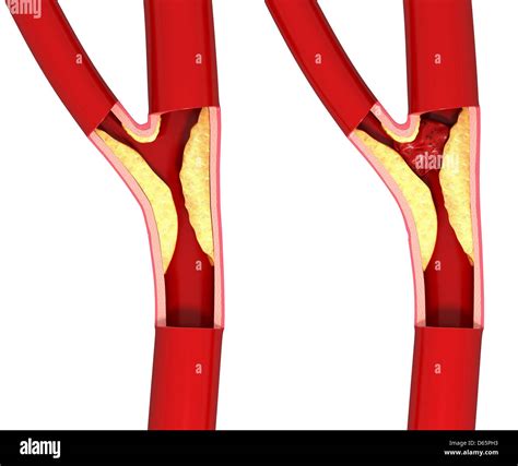 Atherosclerosis Aorta High Resolution Stock Photography And Images Alamy